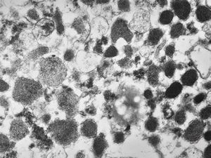 unclassified pancreatic tumor unclassified pancreatic tumor